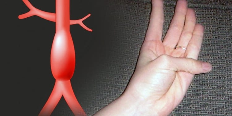 thumb palm aortic aneurysm