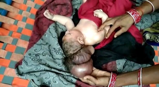 0 PAY Woman who had normal pregnancy gives birth to THREE HEADED baby 1